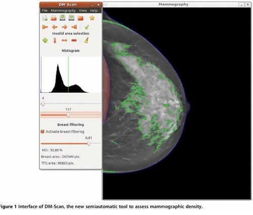 El software  DMscan quantifica la densitat de la mama, un valor directament relacionat amb el risc de patir la patologia.