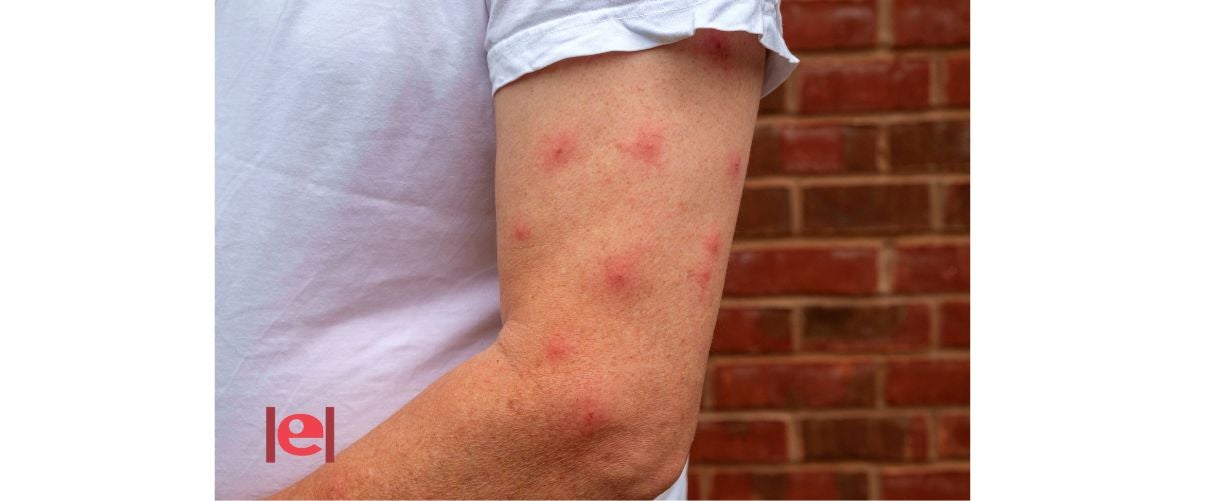 Maleïts mosquits!!!, què fer per a evitar les picades