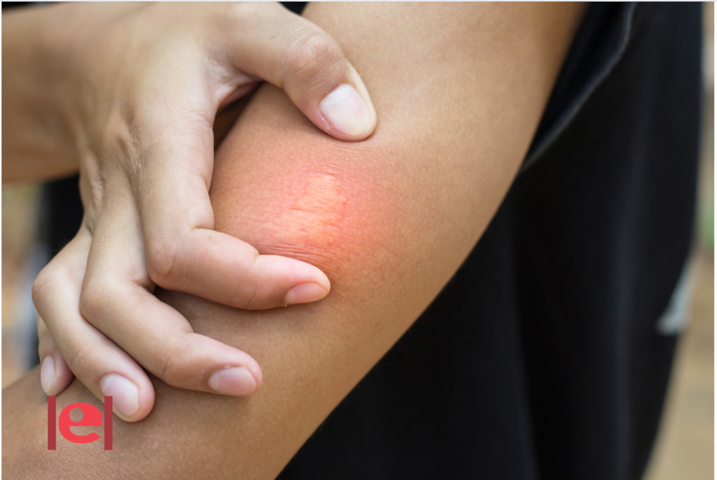 Insectes, sol i aliments, les causes d’al·lèrgies més freqüents a l’estiu